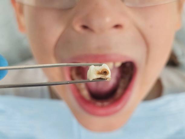 Best Emergency Dental Care for Broken or Chipped Teeth in Taylor Mill, KY